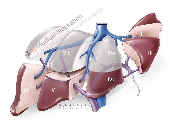 minor resections