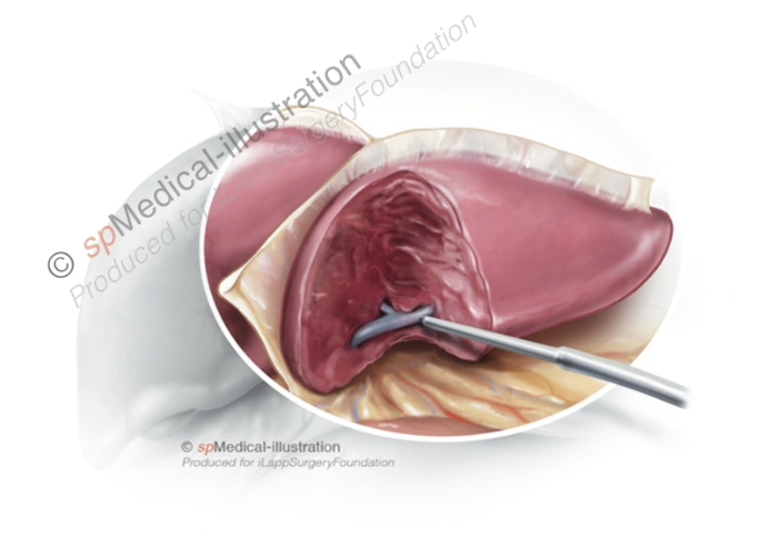 second step the portal pedicles to segment