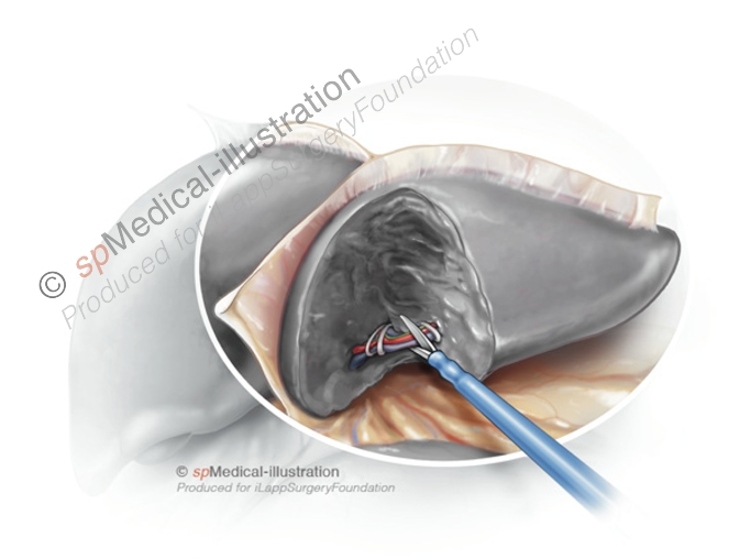 Division of portal pedicles to segment 2 & 3
