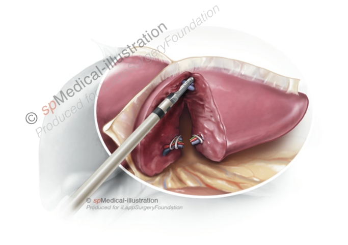 Step 5. Stapling of the left hepatic vein