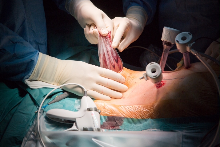 Step 7. Extraction of the specimen