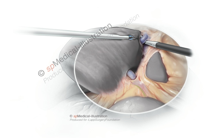 Laparoscopic left hemihepatectomy5