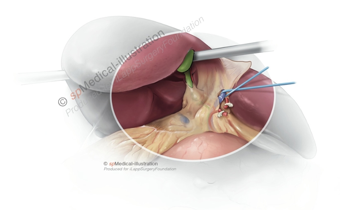 Laparoscopic left hemihepatectomy9