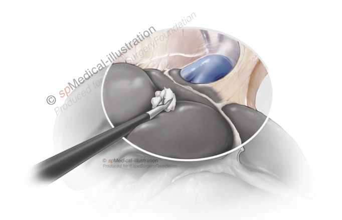 Laparoscopic right hemihepatectomy3