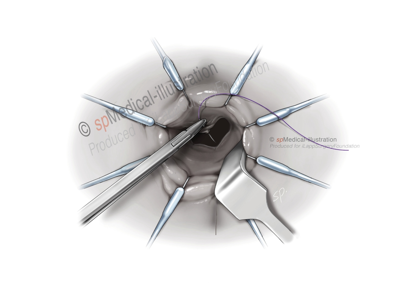 optimal pursestring5