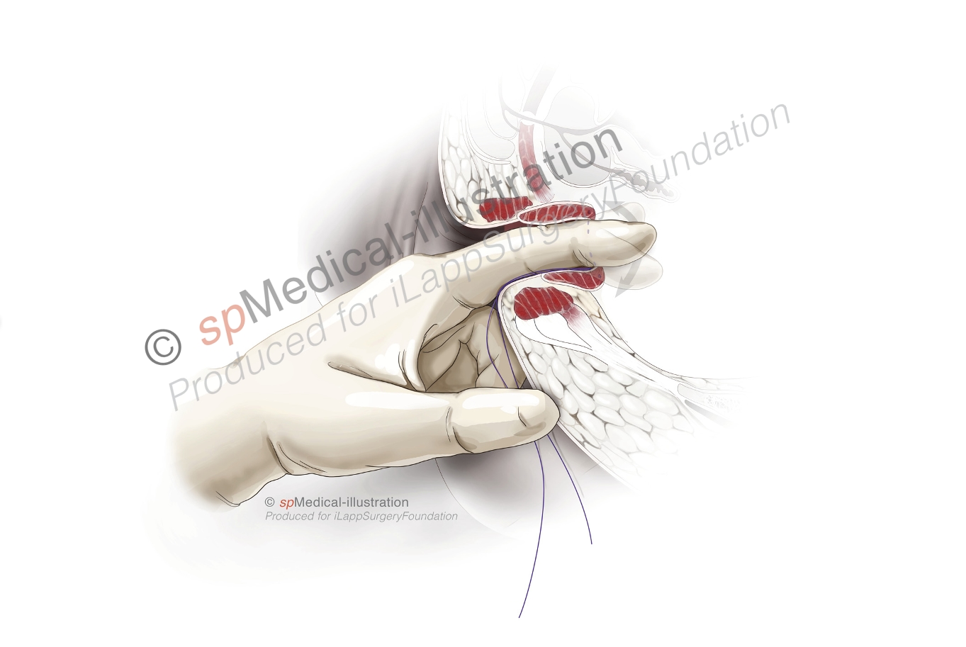 optimal pursestring8
