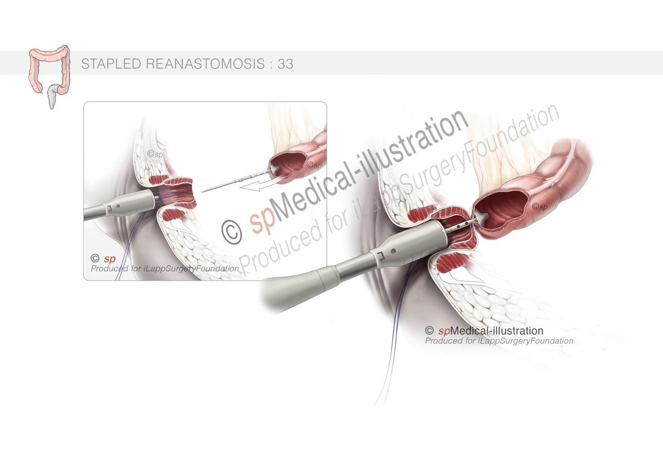 optimal pursestring9