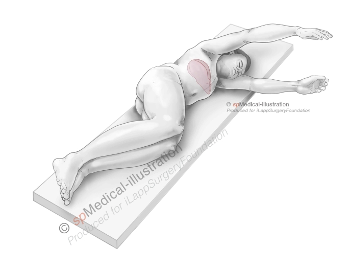Introduction to difficult posterosuperior segments2