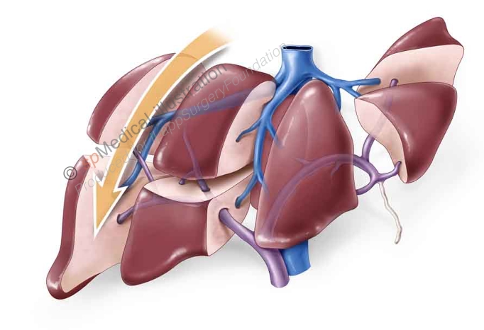 Laparoscopic posterior segmentectomy