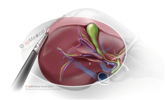 Laparoscopic posterior segmentectomy2