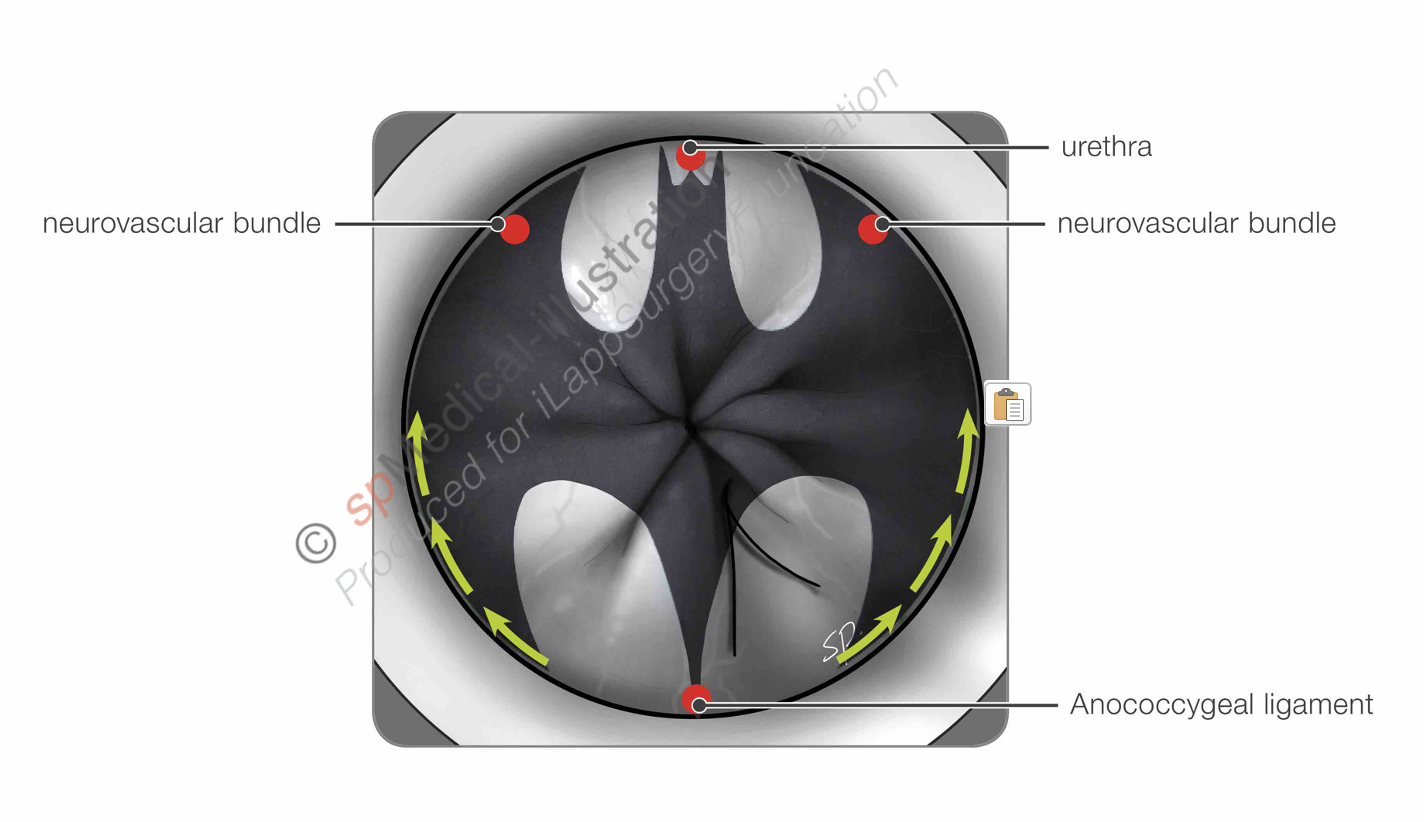 Distal Lateral plane 