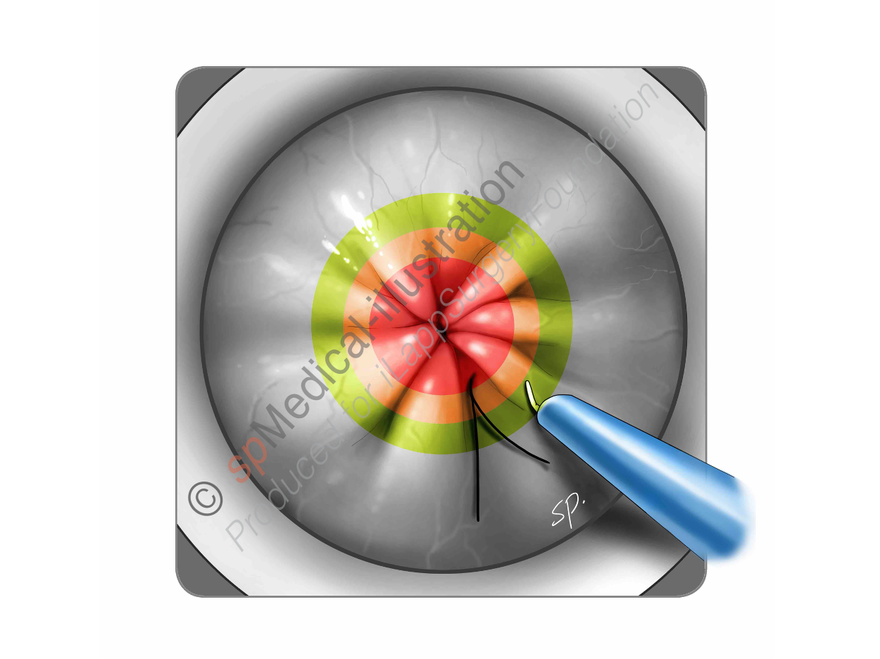 Marking the line of rectotomy