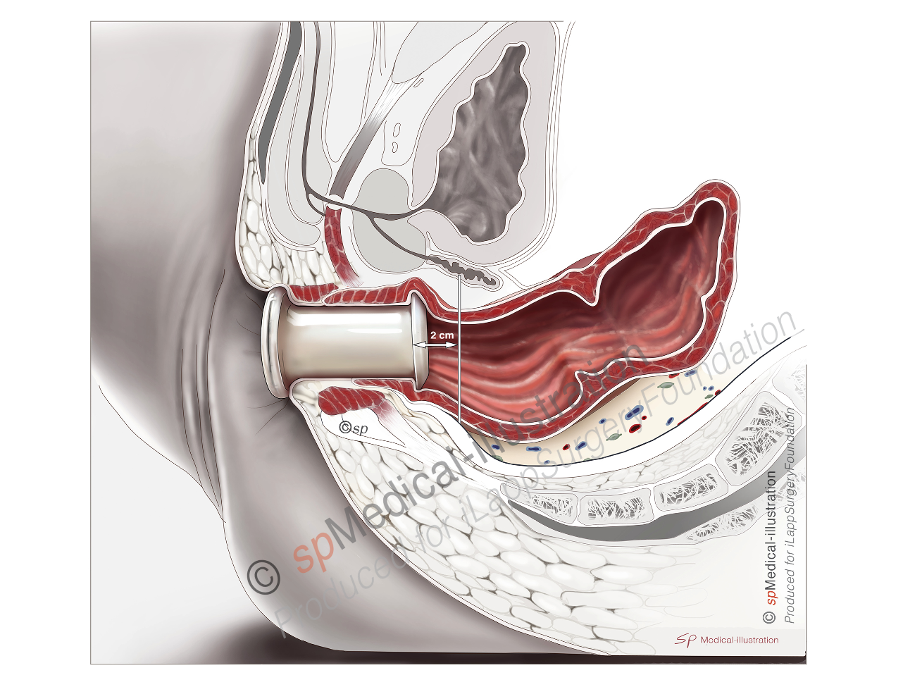 Position of Pursestring