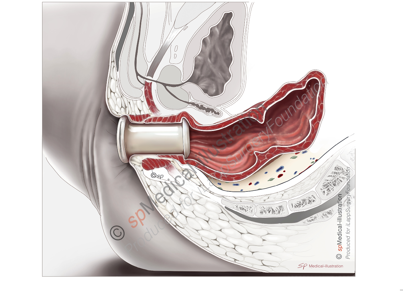 Position of Pursestring