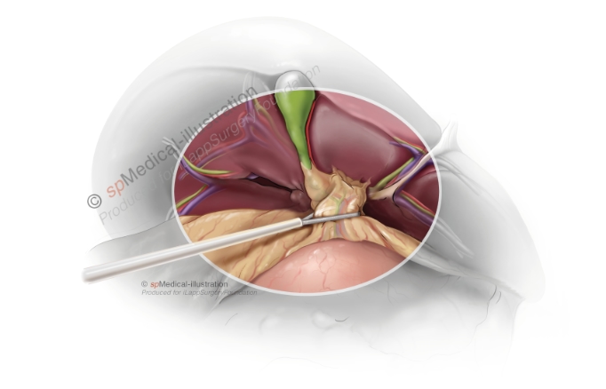 tekening - Laparoscopic Pringle Manoeuvre 