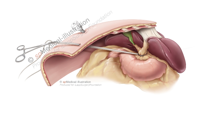 tekening é Laparoscopic Pringle Manoeuvre 