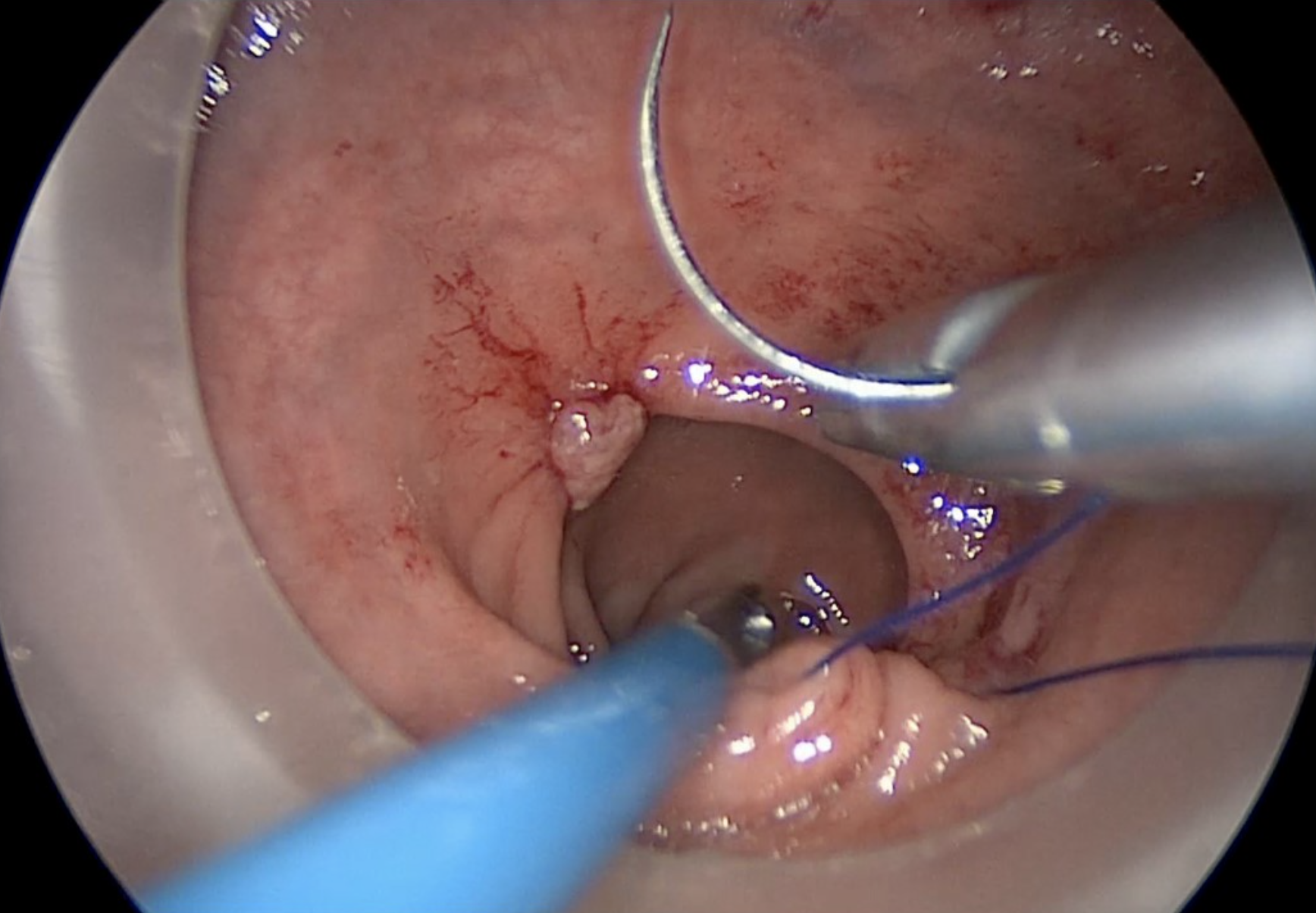 Transanal technique