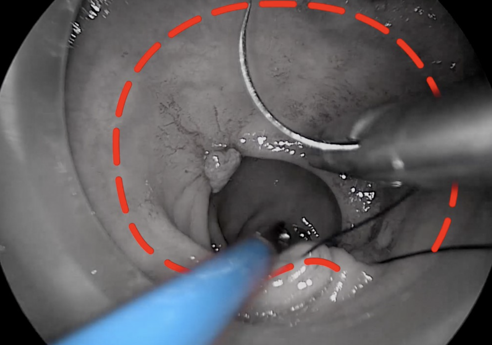 Transanal technique2