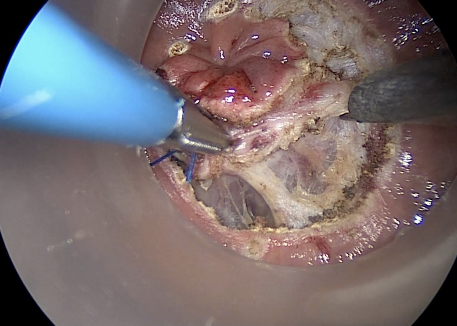 Transanal technique5