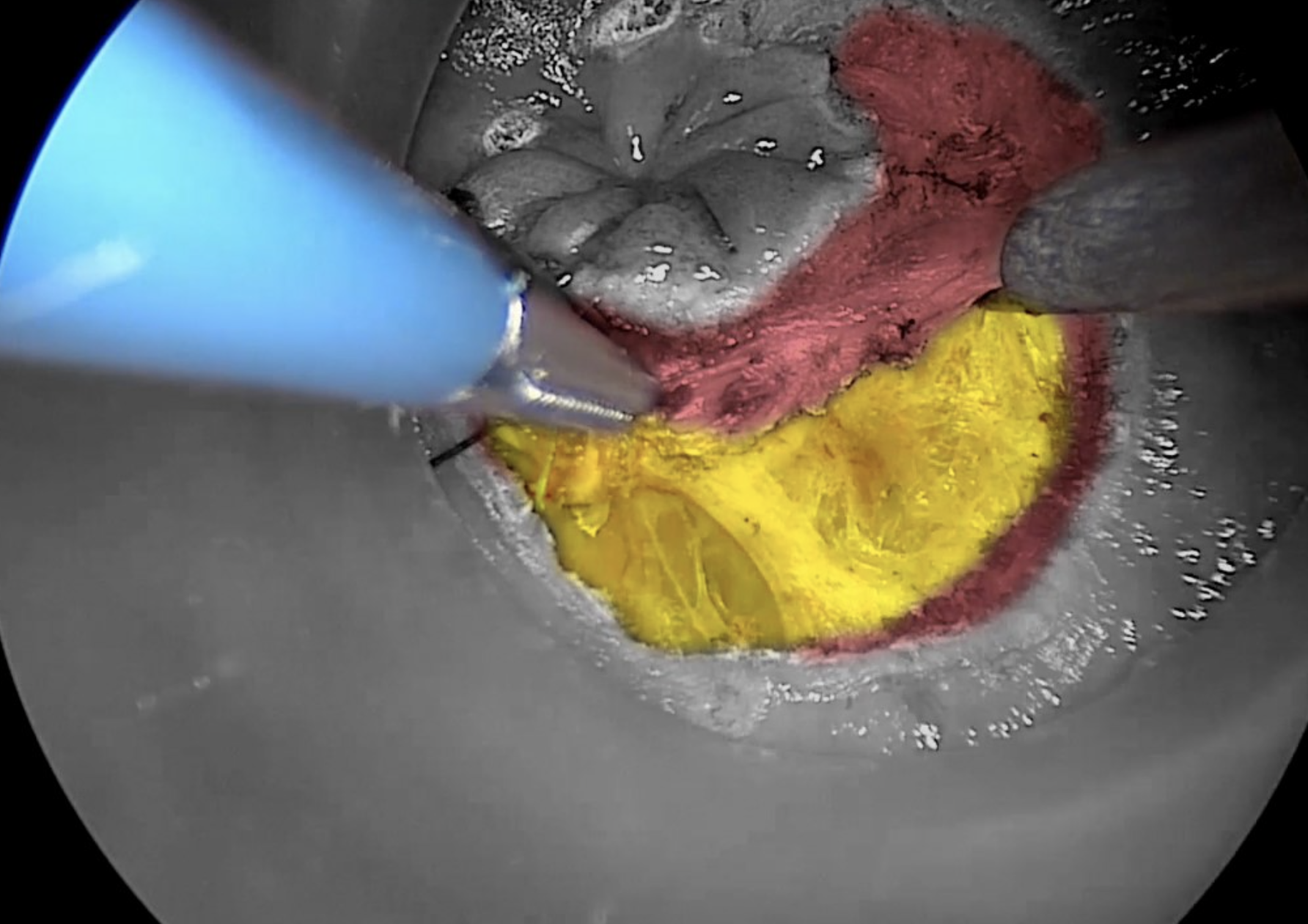 Transanal technique6