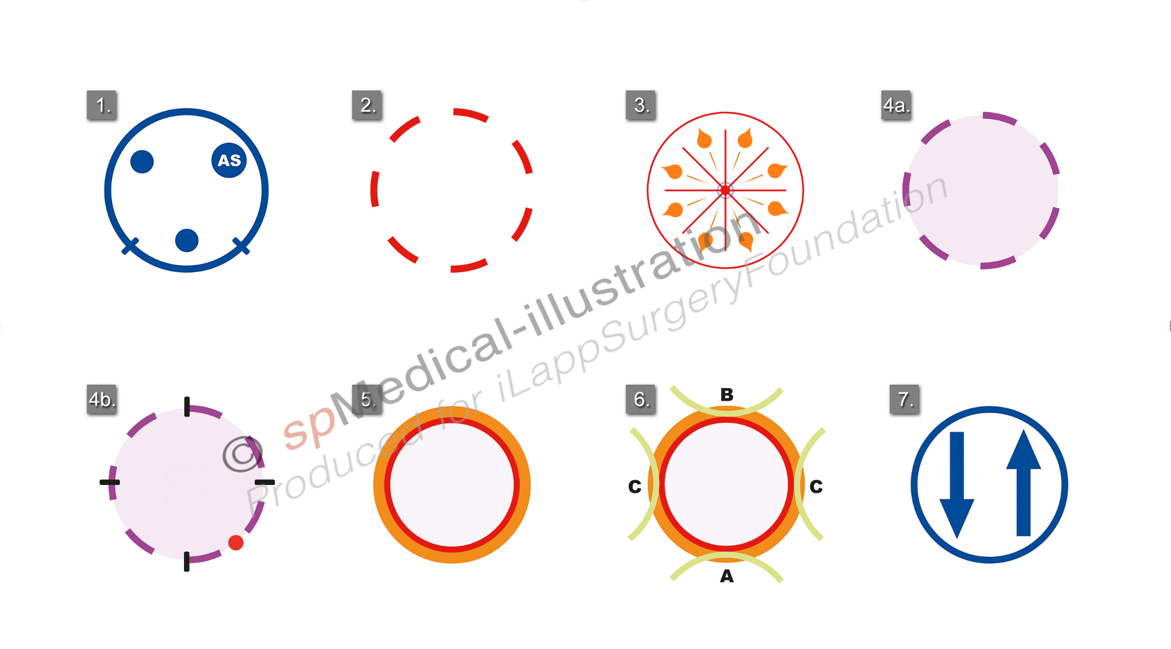 extracted transanally
