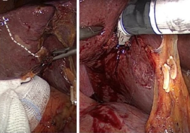 foto-Laparoscopic posterior segmentectomy