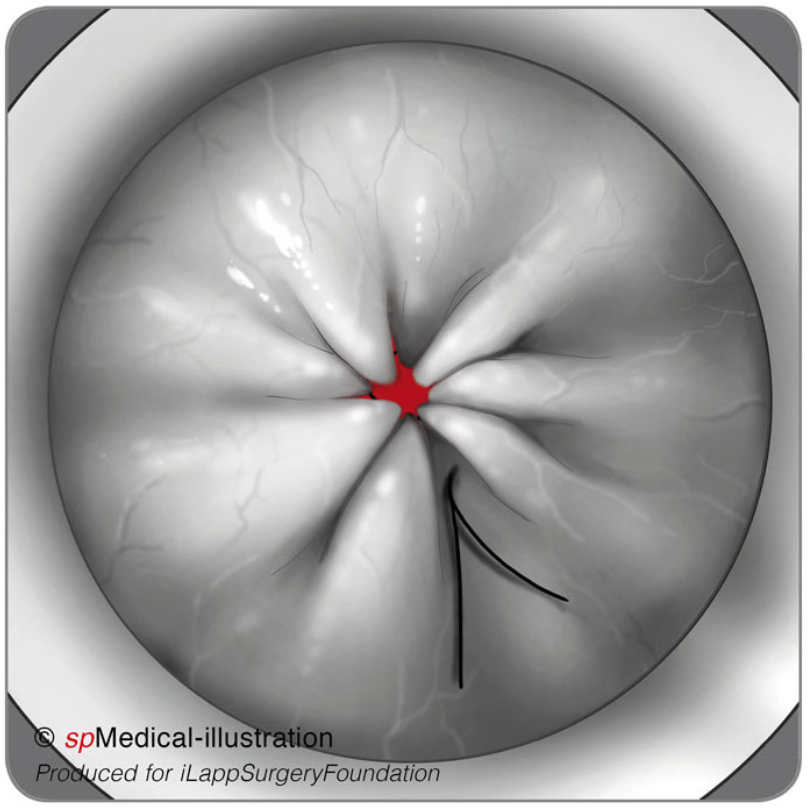 Placement of Pursestring5