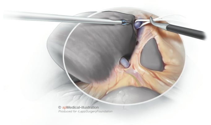 Laparoscopic left hemihepatectomy7