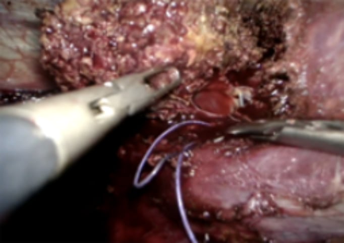 Picture showing large tear in right hepatic vein