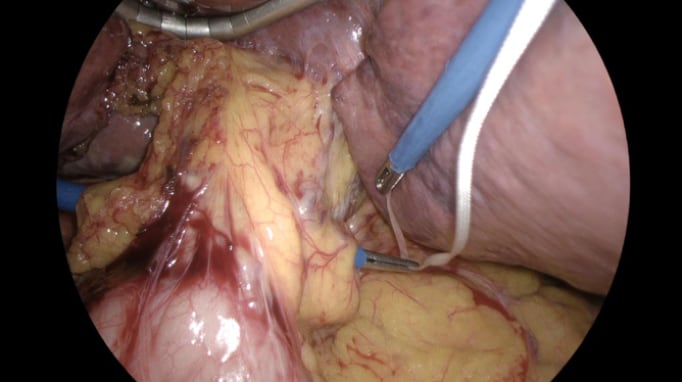 Laparoscopic Pringle Manoeuvre 2