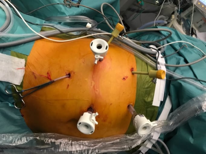 Laparoscopic Pringle Manoeuvre 9